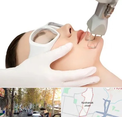 لیزر فرکشنال در کاشانک