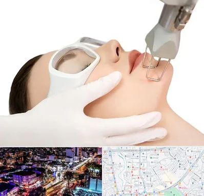 لیزر فرکشنال در منظریه رشت