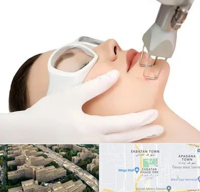 لیزر فرکشنال در اکباتان 