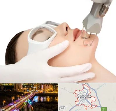 لیزر فرکشنال در سقز