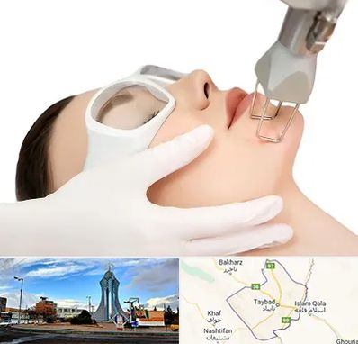 لیزر فرکشنال در تایباد