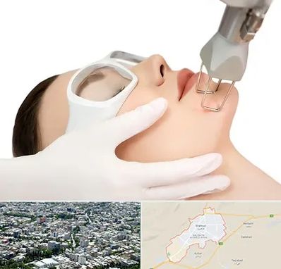 لیزر فرکشنال در شاهرود