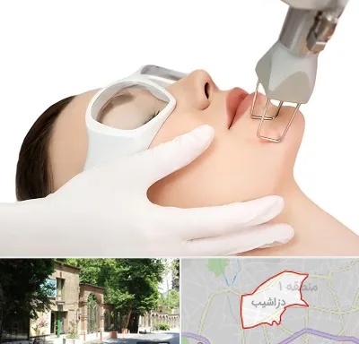 لیزر فرکشنال در دزاشیب