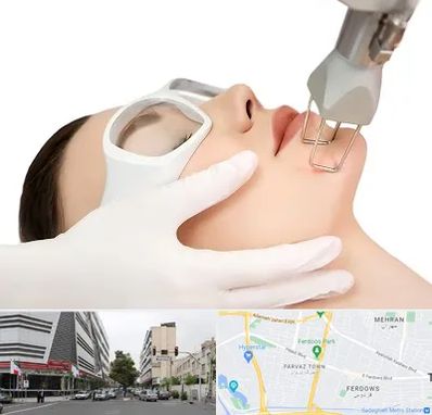 لیزر فرکشنال در بلوار فردوس 