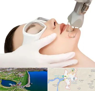 لیزر فرکشنال در مهاباد