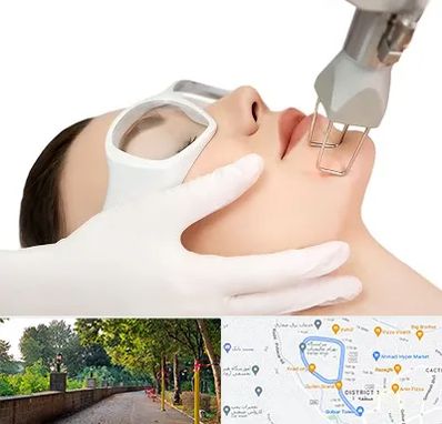 لیزر فرکشنال در بلوار گیلان رشت