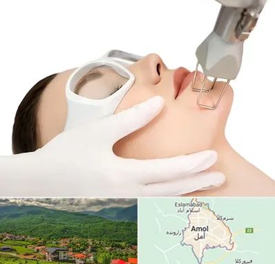 لیزر فرکشنال در آمل