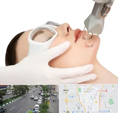 لیزر فرکشنال در ستارخان 