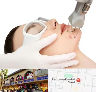 لیزر فرکشنال در 15 خرداد