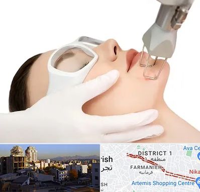 لیزر فرکشنال در فرمانیه 