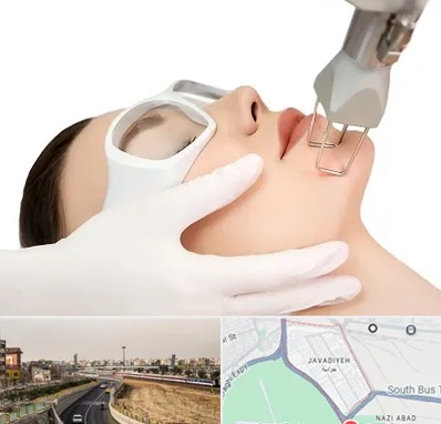 لیزر فرکشنال در جوادیه