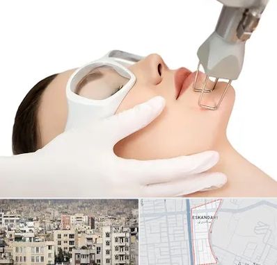 لیزر فرکشنال در اسکندری