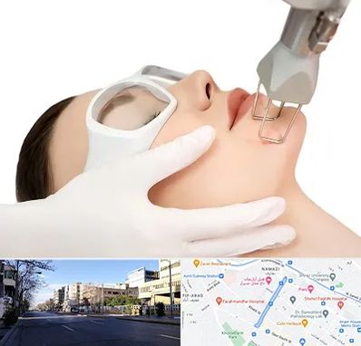 لیزر فرکشنال در خیابان ملاصدرا شیراز