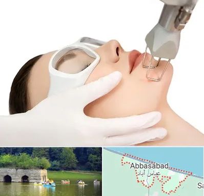 لیزر فرکشنال در عباس آباد