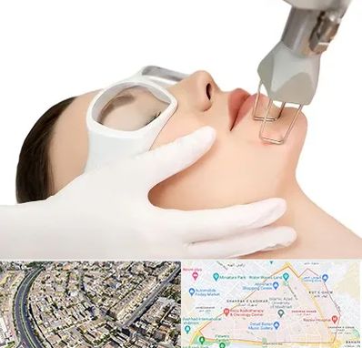 لیزر فرکشنال در شهرک غرب مشهد