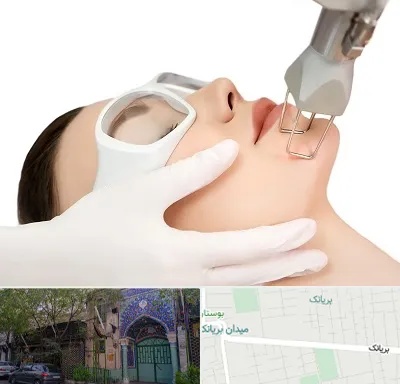 لیزر فرکشنال در بریانک