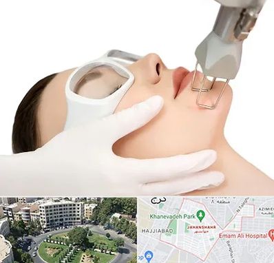 لیزر فرکشنال در جهانشهر کرج 