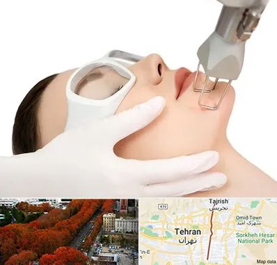 لیزر فرکشنال در ولیعصر 