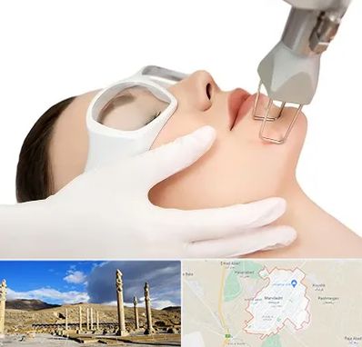 لیزر فرکشنال در مرودشت