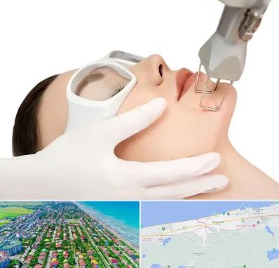 لیزر فرکشنال در فریدونکنار