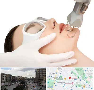 لیزر فرکشنال در بلوار فردوسی مشهد 