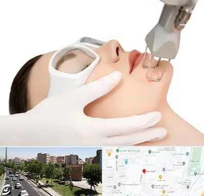 لیزر فرکشنال در شهرک آزمایش 