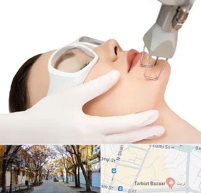 لیزر فرکشنال در تربیت تبریز