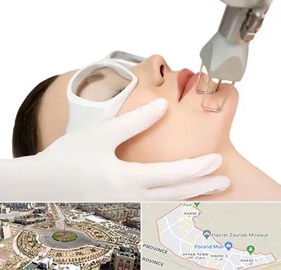 لیزر فرکشنال در پرند