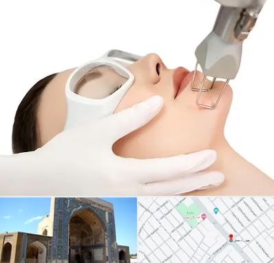 لیزر فرکشنال در مصلی مشهد