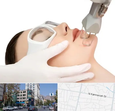لیزر فرکشنال در کامرانیه