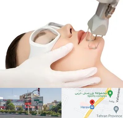 لیزر فرکشنال در هروی 