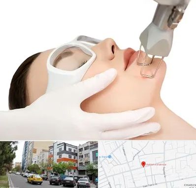 لیزر فرکشنال در هفده شهریور تبریز