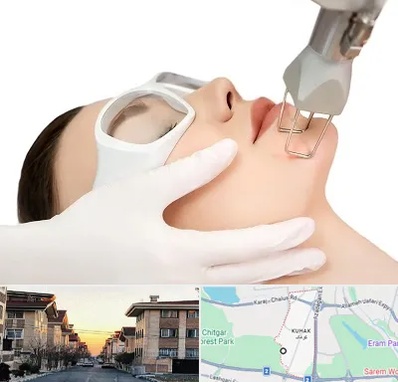 لیزر فرکشنال در کوهک
