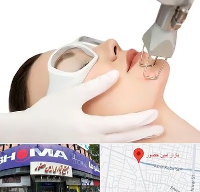 لیزر فرکشنال در امین حضور