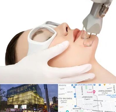 لیزر فرکشنال در جمهوری 