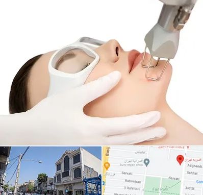 لیزر فرکشنال در افسریه 