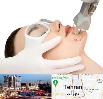 لیزر فرکشنال در صادقیه 