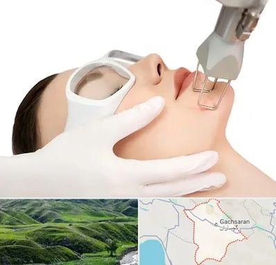 لیزر فرکشنال در گچساران