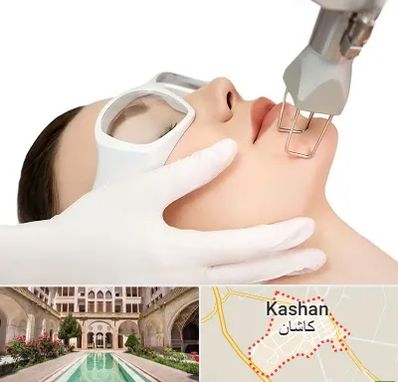 لیزر فرکشنال در کاشان