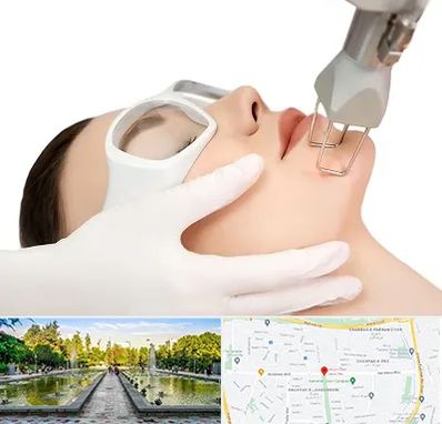 لیزر فرکشنال در سرسبز 