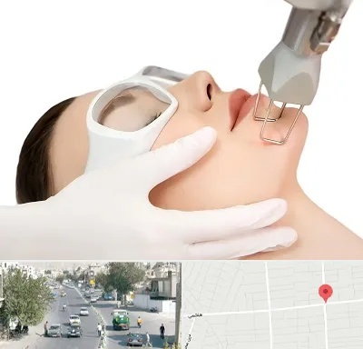 لیزر فرکشنال در هاشمی