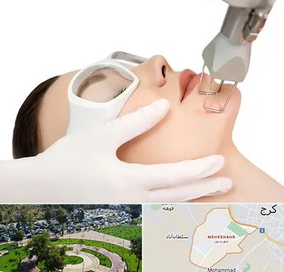 لیزر فرکشنال در مهرشهر کرج 