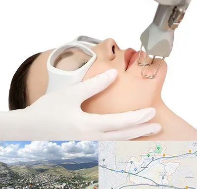 لیزر فرکشنال در رودهن