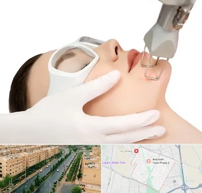 لیزر فرکشنال در فاز سه اندیشه