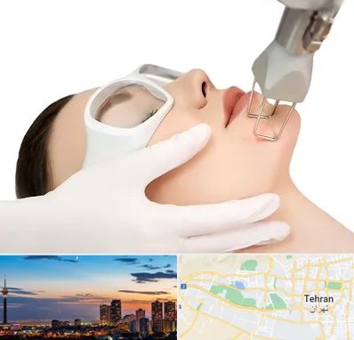 لیزر فرکشنال در غرب تهران 