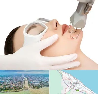 لیزر فرکشنال در تنکابن