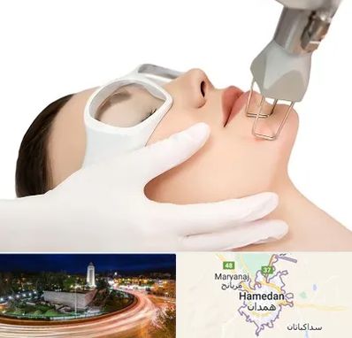 لیزر فرکشنال در همدان