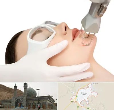 لیزر فرکشنال در شهرضا