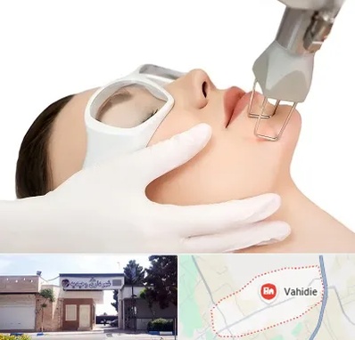 لیزر فرکشنال در وحیدیه شهریار