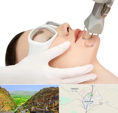 لیزر فرکشنال در کامیاران